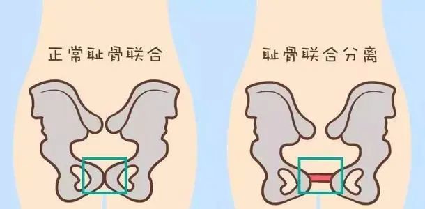 耻骨联合分离是因为孕期缺乏运动,松弛素,肥胖等因素导致的,这是一个